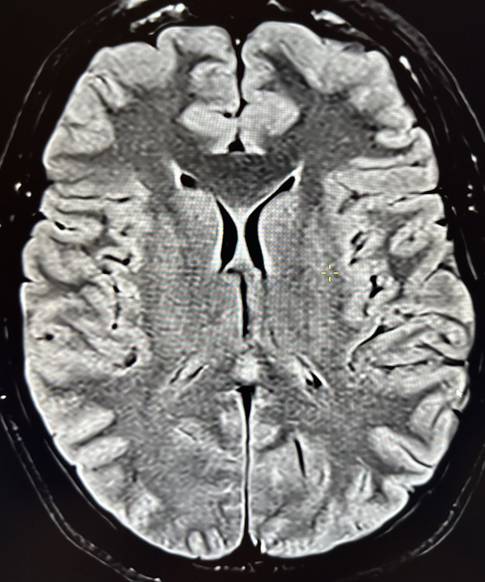 Sudden headache during post-partum #MRI depicts a corpus callosum lesion What’s your hypothesis ? #FOAMrad #Radiology #RadTwitter