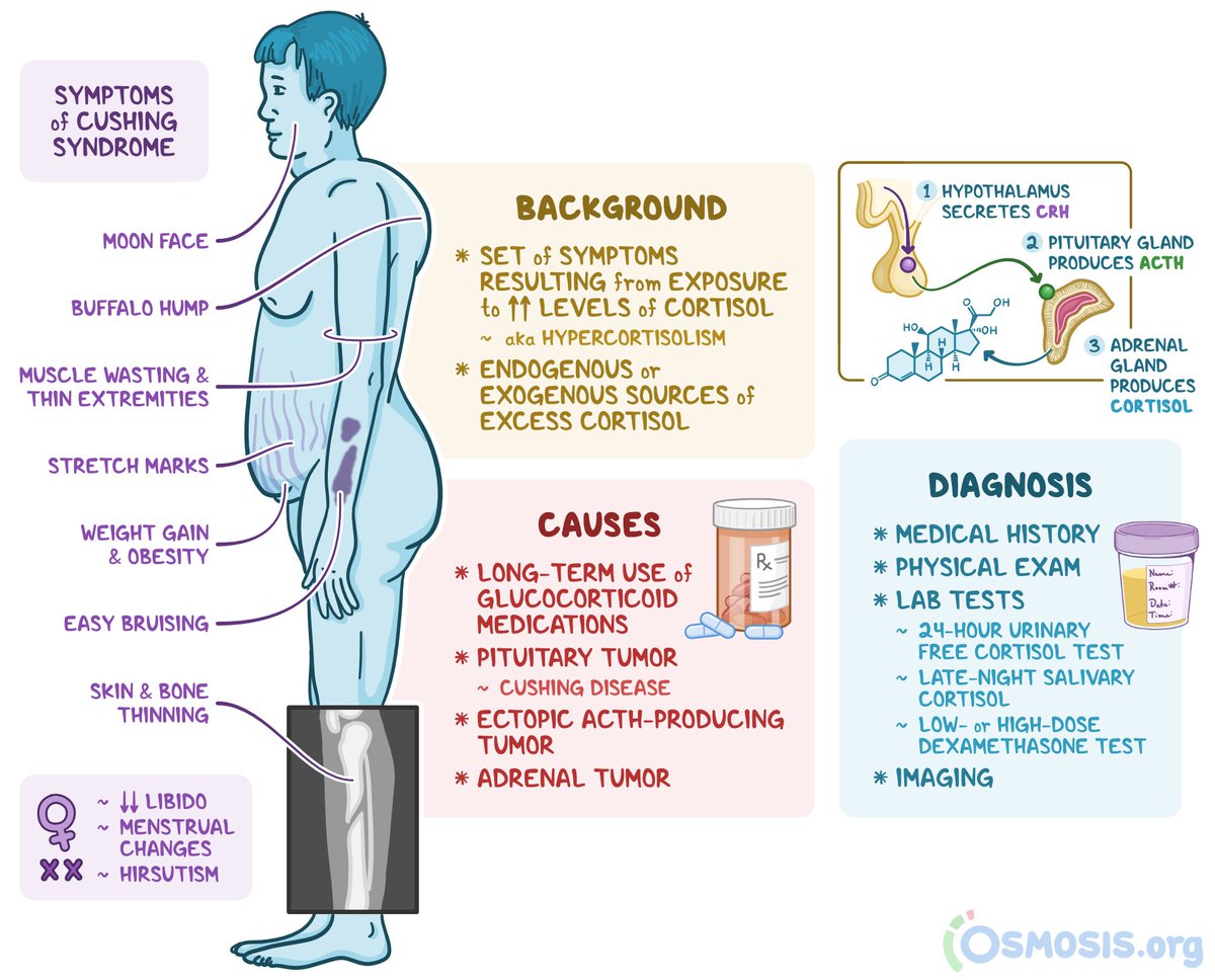 @IhabFathiSulima CUSHING SYNDROME #Medtwitter #MedEd #MedX
Caused by prolonged exposure to high circulating levels of cortisol. Most common cause of cushingoid features is iatrogenic corticosteroid use, while some herbal preparations can also increase circulating corticosteroid levels leading to