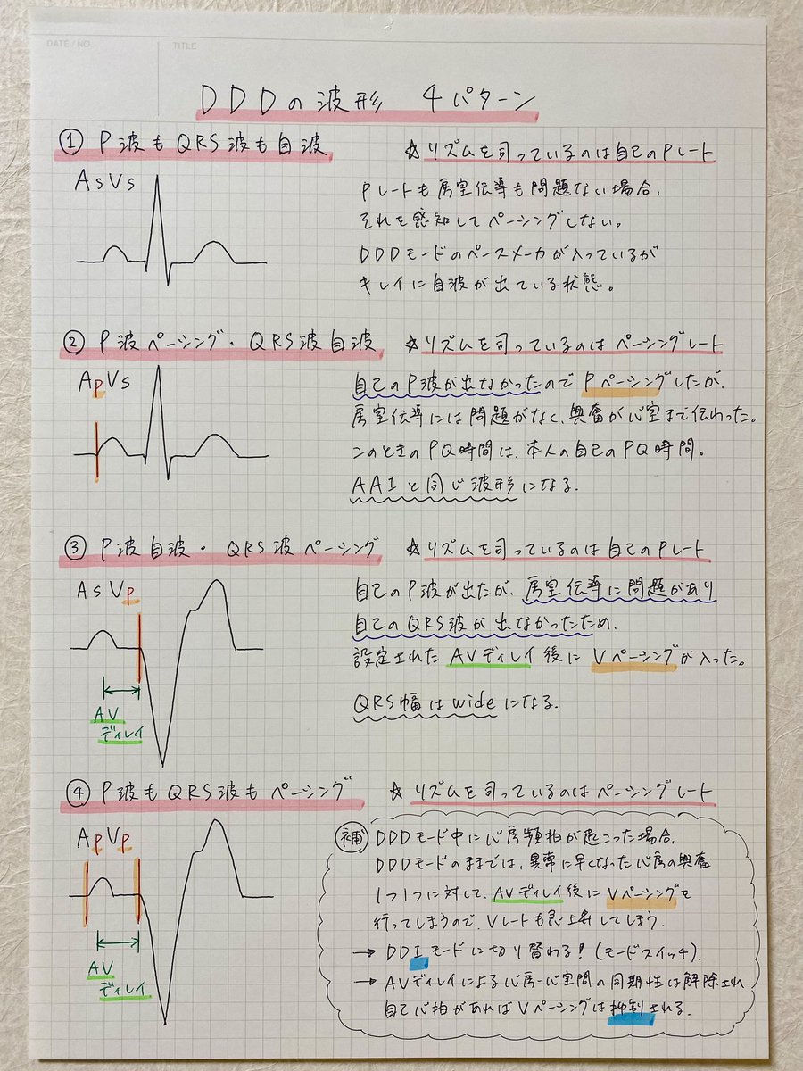 DDDモードの波形についてまとめました！🌟
苦手でしたが、じっくり勉強したらだいぶ理解が深まりました☺️✨
#心電図
#ペースメーカ波形
#DDD