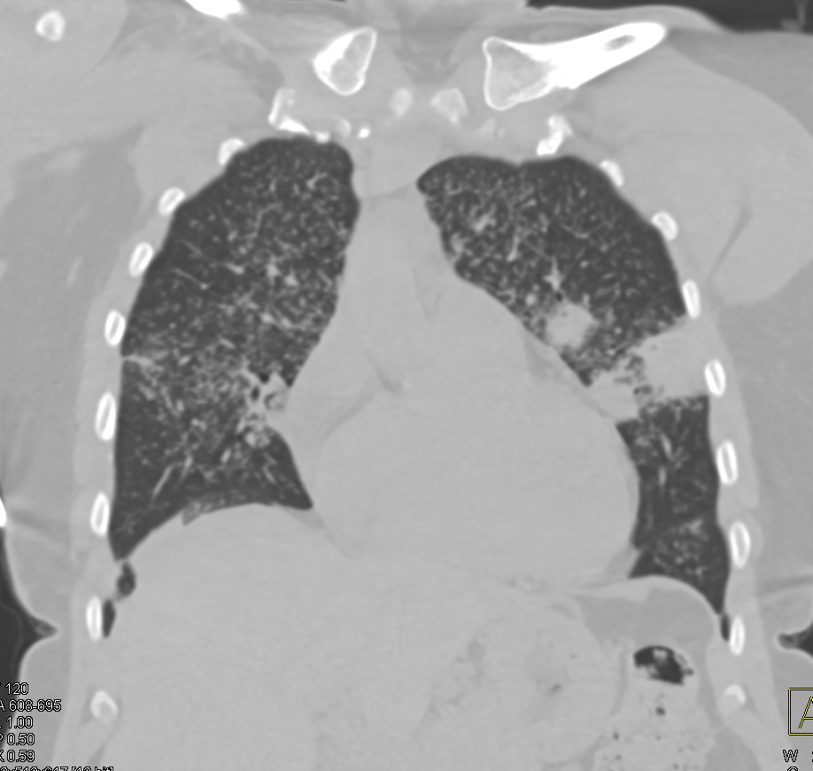 lymphoma in the lungs