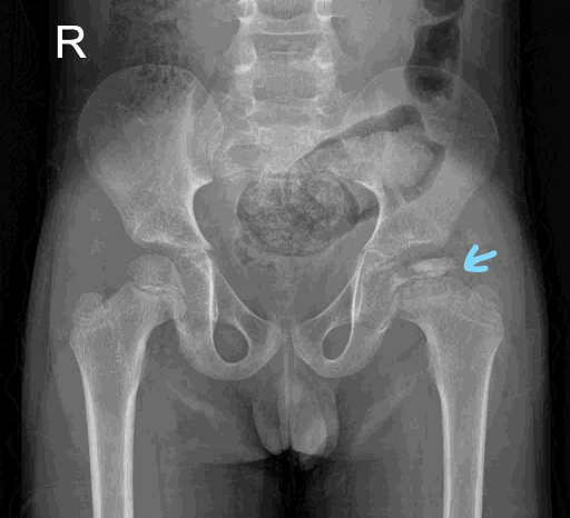PANAFRMEDJ's tweet image. What is your diagnosis?
✨Legg-Calve-Perthes disease ✨Multiple epiphyseal dysplasia ✨Septic arthritis ✨Osteomyelitis

Respond @ #ThePAMJ

panafrican-med-journal.com/quizz/index.ph…

#imagequiz