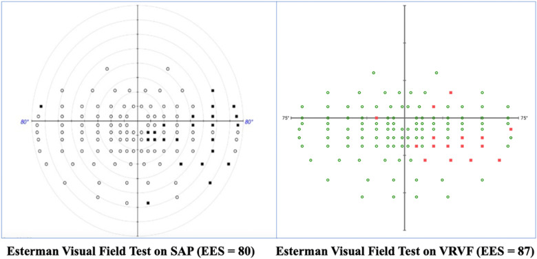 New @bascompalmereye study tested the use of #virtualreality VFs to implement the Esterman driving VF test. With only fair concordance to standard automated perimetry, it's a promising option, but not ready for primetime. #ophthalmology #glaucoma ow.ly/E11z50RohJX