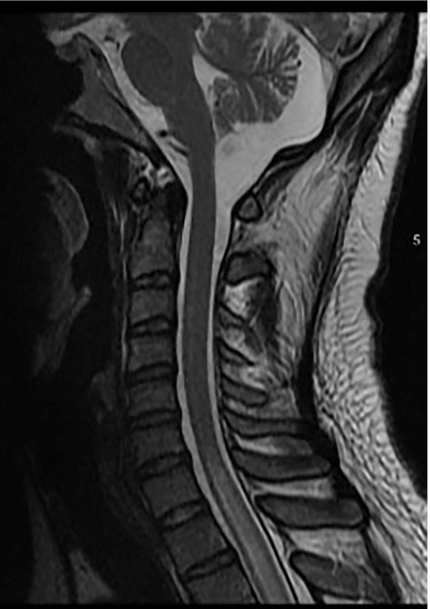 From the January-March 2024 Issue of #Neurographics: Imaging and Clinical Characteristics of Epstein-Barr Virus Myelitis in a Patient with a History of Hemophagocytic Lymphohistiocytosis in Remission ow.ly/Irc850RuRsb