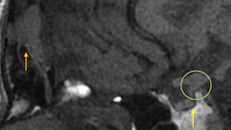JordiRoldanB's tweet photo. Langerhans Cell Histiocytosis (LCH). Three in a row: 
🟠 lytic skull mass
🟢 pituitary stalk thickening
🟡 absent posterior pituitary T1 hyperintensity

Put the pieces of the puzzle together. https://t.co/bpePHkfUvw