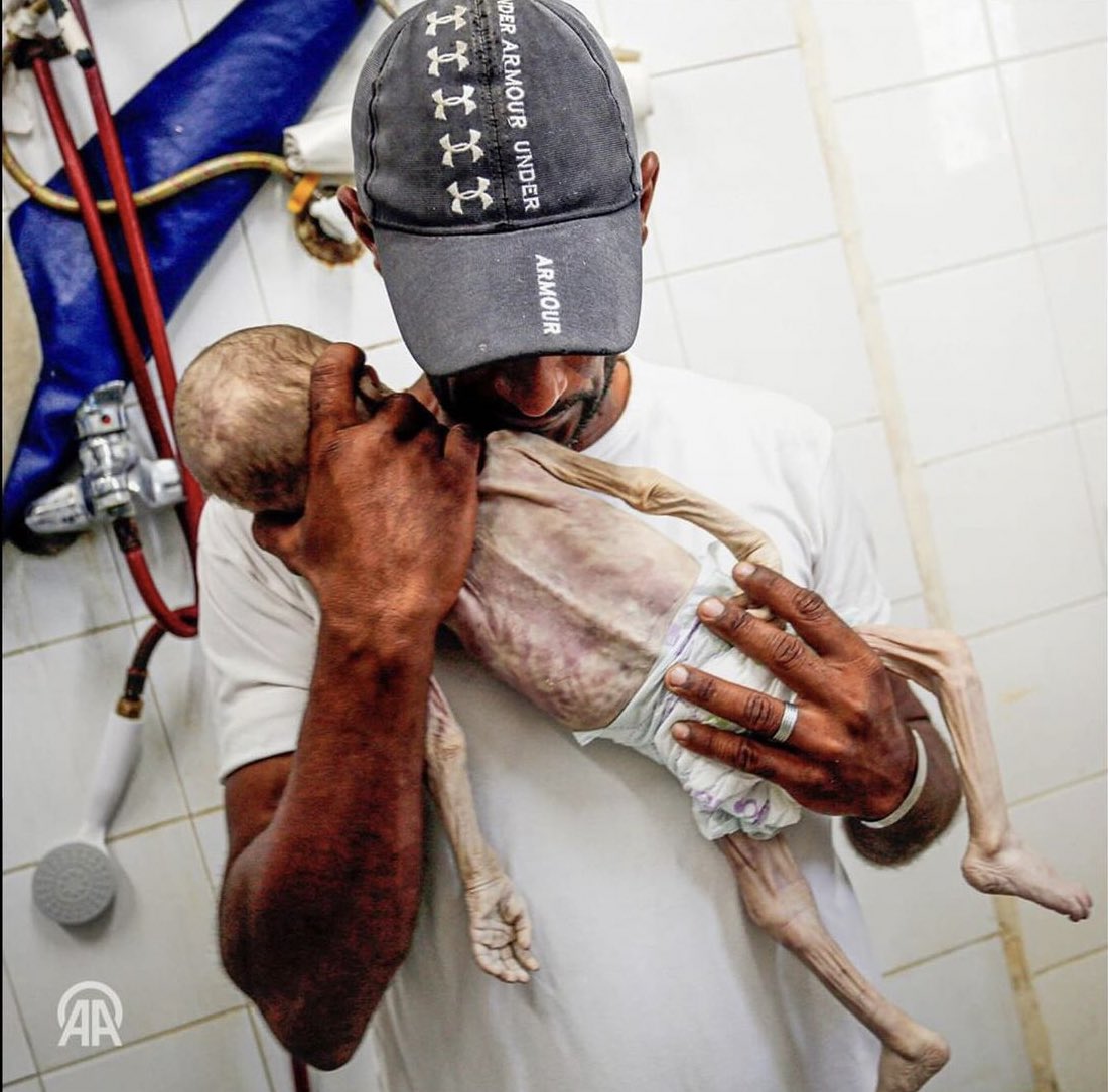 Ongoing Humanitarian Crisis | 7 month old Fayez Abu-'Ataya has passed away due to malnutrition caused by the ongoing lsraeli-imposed siege in Gaza.