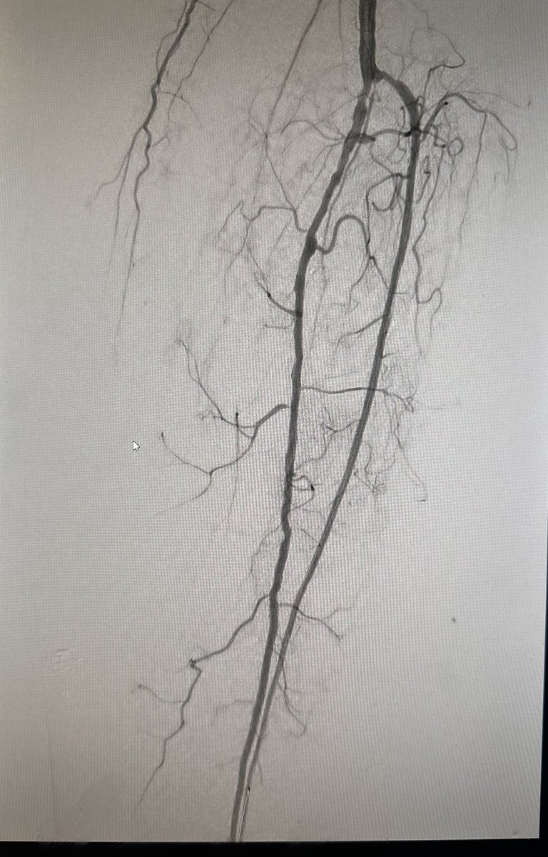 85 yo with 🦶 claudication and no longer has foot claudication. @farkomd @SDhandMD @t_intheleadcoat @AmputationSuck @_backtable @canuc_57 #itdoesntexistexceptwhenitdoes