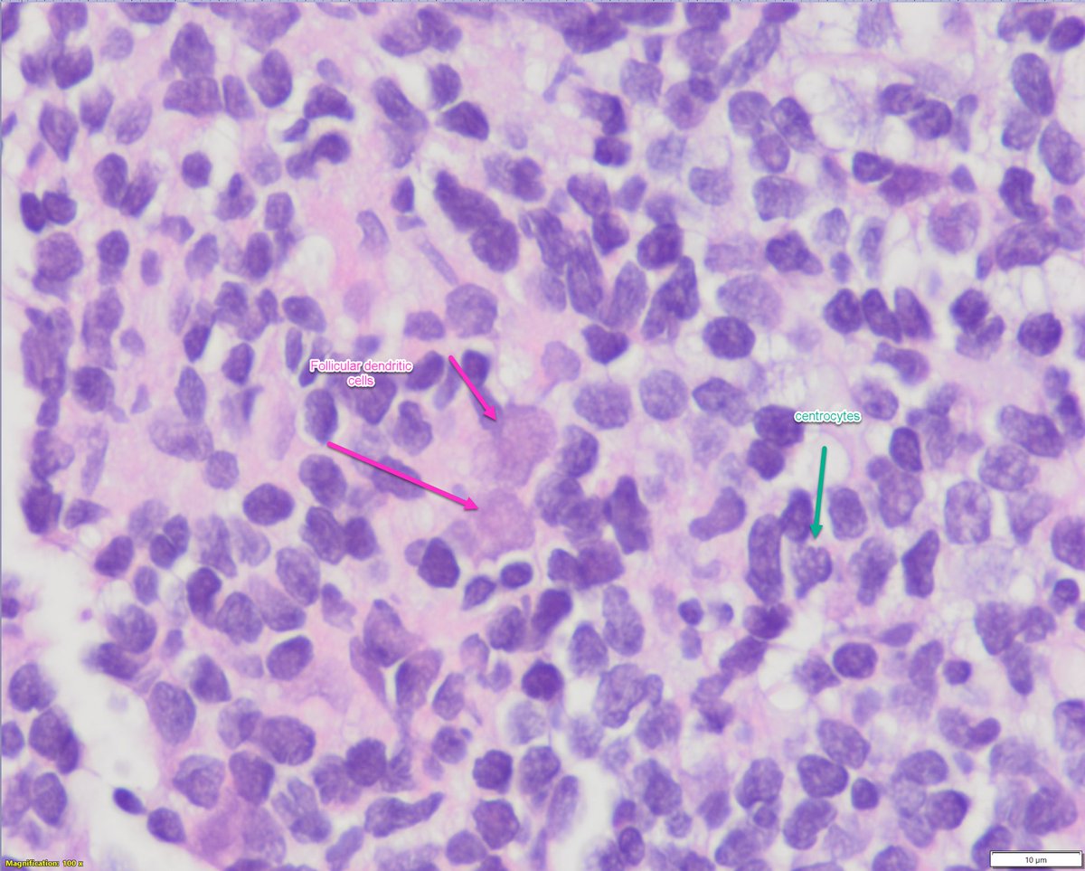 Sanam Loghavi, MD صنم لغوی 🔬🧬 tweet media