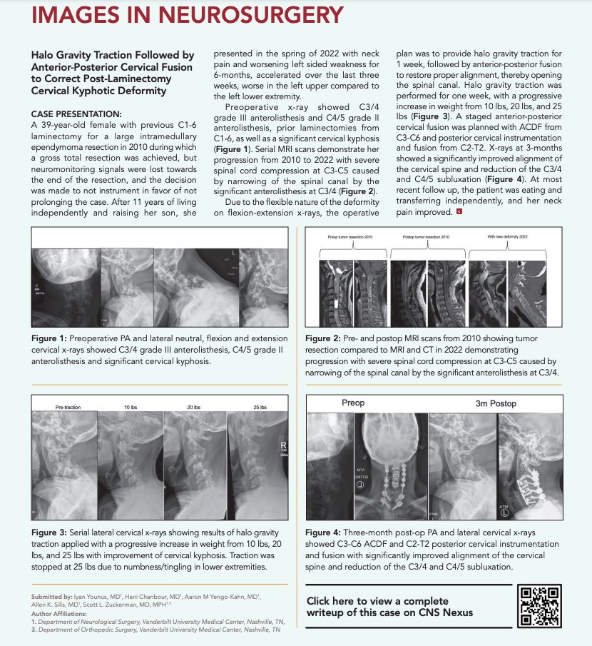 Appreciate the feature of our case in <a href="/CNS_Update/">CNS</a> Quarterly magazine @VUMC_Spine_Lab <a href="/ScottZuck/">Scott Zuckerman, MD, MPH</a> <a href="/KahnYengo/">Aaron Yengo-Kahn</a> <a href="/dr_sills/">Allen Sills</a> <a href="/HaniChanbour/">Hani Chanbour MD</a>