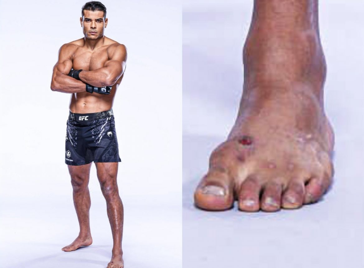 Paulo Costa got Staph Infection too 💀