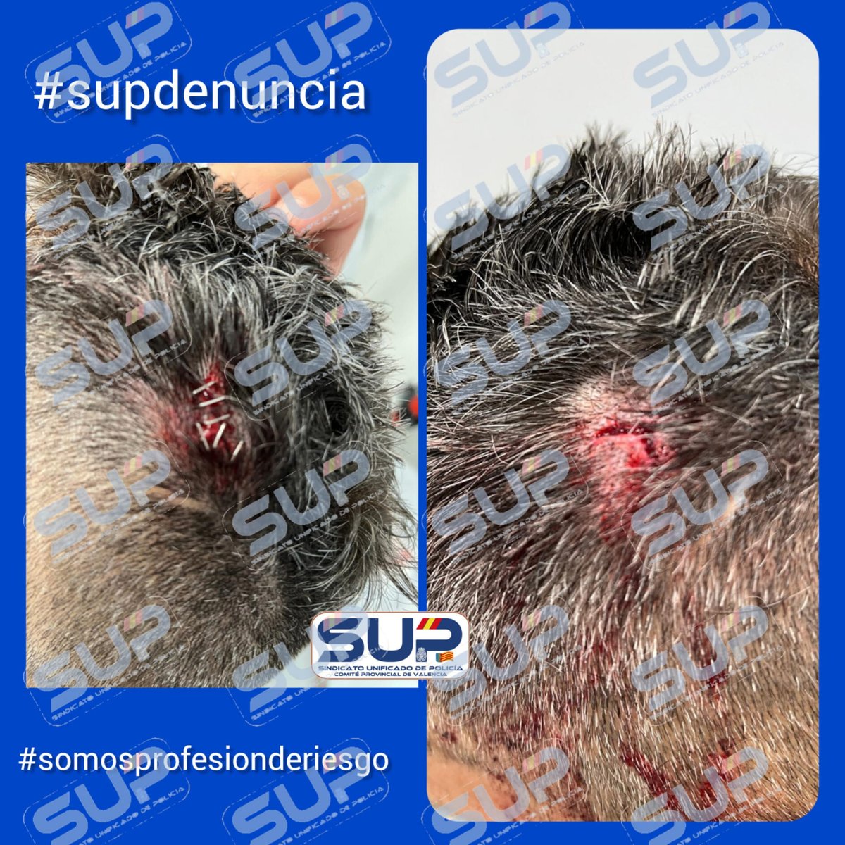 Desde @Sup_policia denunciamos la agresión a un compañero sufrida en #Valencia
#PolicíaNacional sigue sin considerarse #ProfesiondeRiesgo
El #PrincipiodeAutoridad queda anulado por el Juez que ha ha puesto en #Libertad al #Agresor