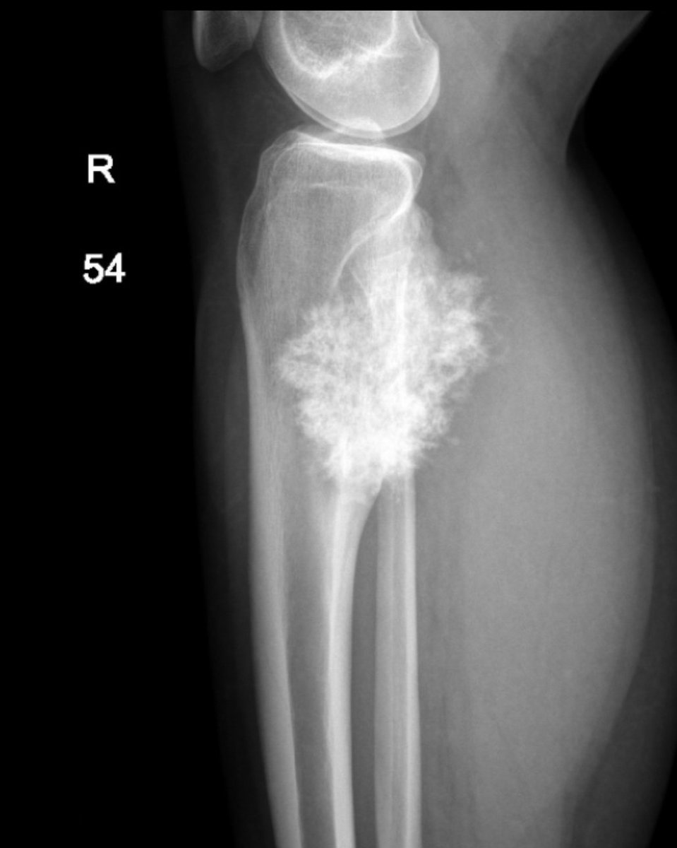 15 years old with knee pain.
What is the diagnosis or Differential?
