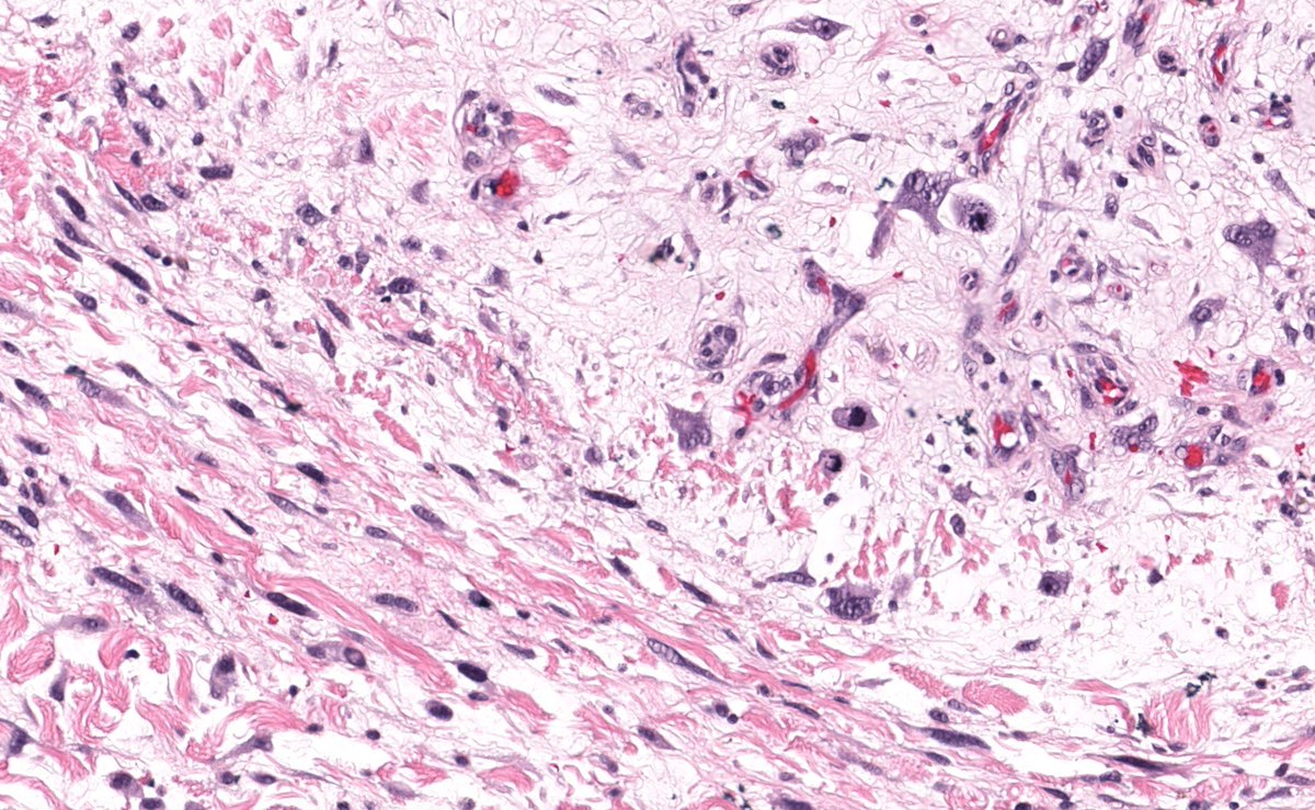 70 yo woman with skin nodule on thigh. Clinical diagnosis: 'sebaceous cyst'. 
Digital slide: kikoxp.com/posts/6807. 
Answer ✅ youtube.com/watch?v=X_mW9G… 
#pathology #pathologists #pathTwitter #dermpath #dermatology #dermatologia #dermtwitter #BSTpath