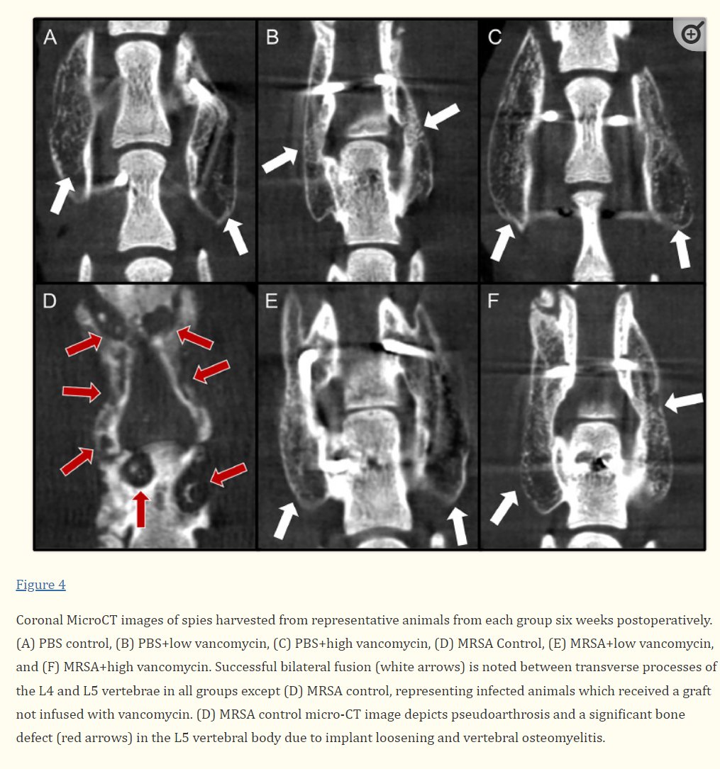 Infection after spinal fusion surgery is a complication that increases patient morbidity. New @HopkinsMedicine study published in @NCBI examines a new tissue engineering approach in instrumented spine surgery to mitigate risk of infection bit.ly/3VpRoWA