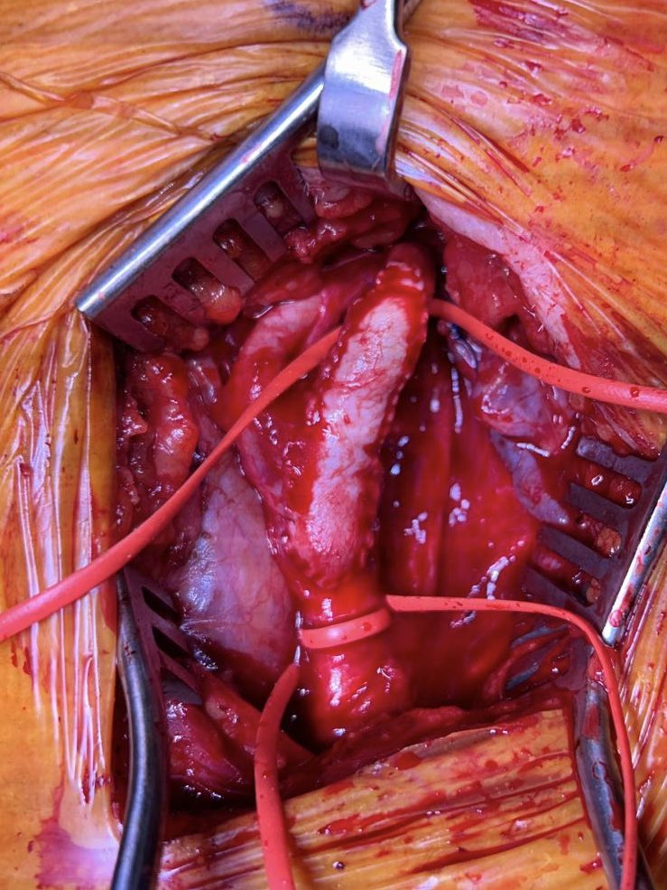 Corkscrew Carotid!!
I don’t think I’ve seen a more tortuous internal carotid before, bending onto itself. Considered resecting redundant bit but it straightened out nicely after an endarterectomy and bovine patch! 
@farkomd @ahmedkayssi @XavierBerardMD #aortaed #vasctwitter