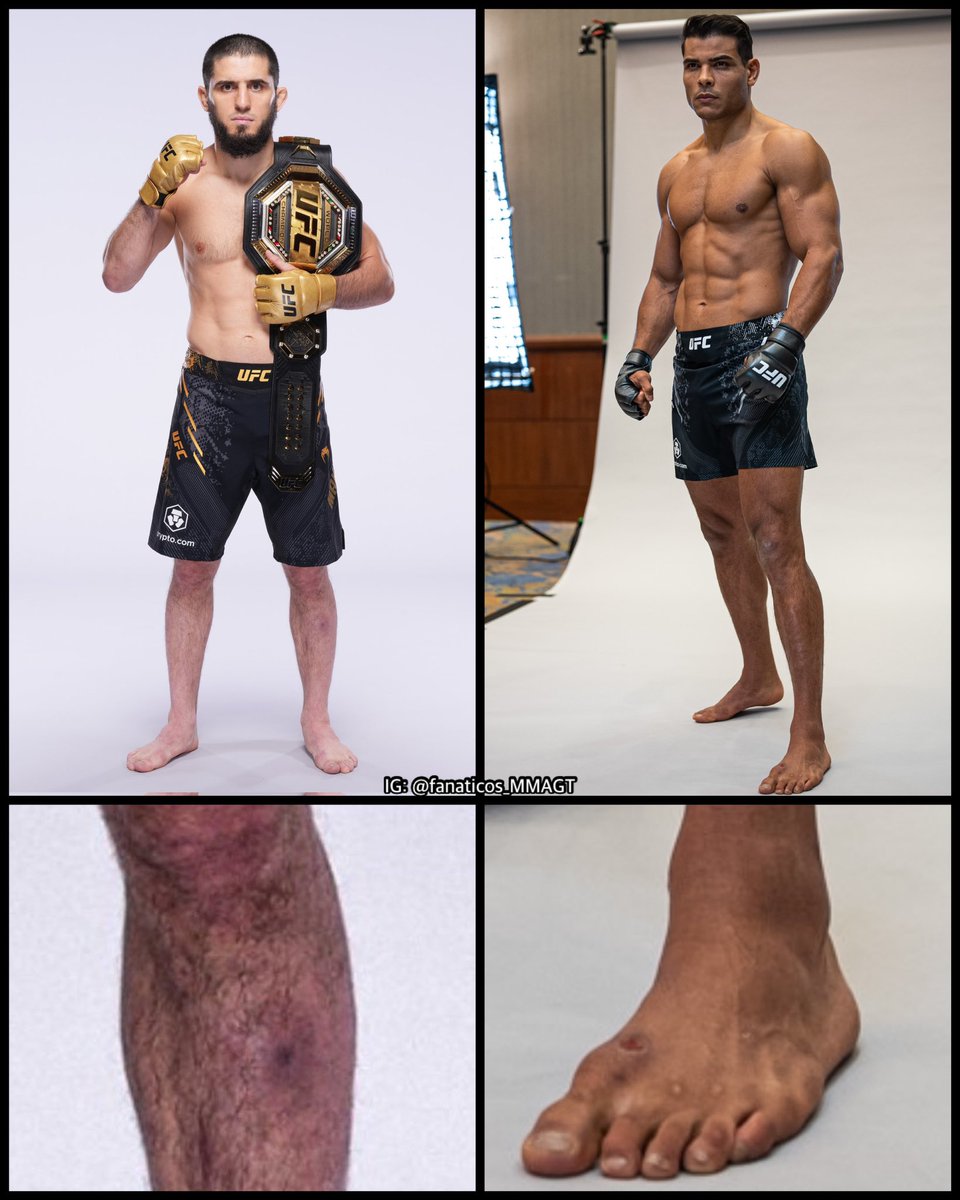 Aprovecho para recordarles uno de los peores casos de Staph Infection del  MMA, Kevin Randleman., image size:960x1200