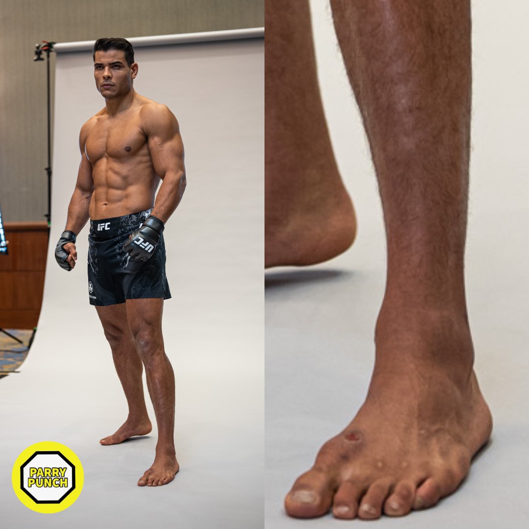 🚨DEVELOPING: Paulo Costa’s latest fight week photos reveal a potentially severe case of staph infection on his left foot. 😳🦠 #UFC302 #UFC #MMA #UFCNewark