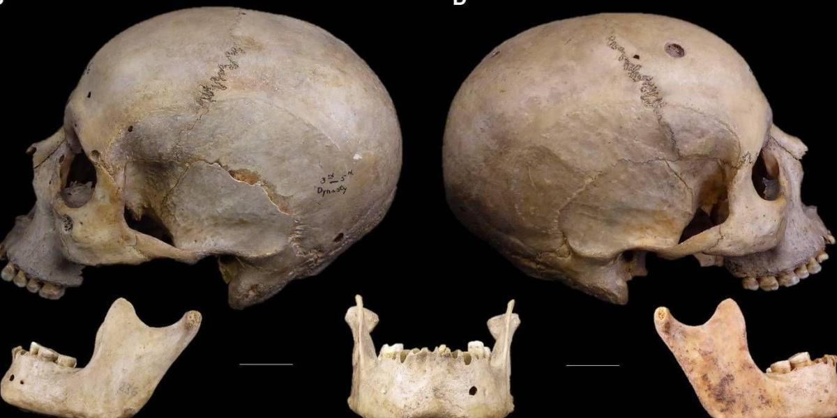 El cráneo de 4.000 años de antigüedad que revela cómo los egipcios trataron de operar el cáncer 🔽 eltiempo.com/mundo/mas-regi…