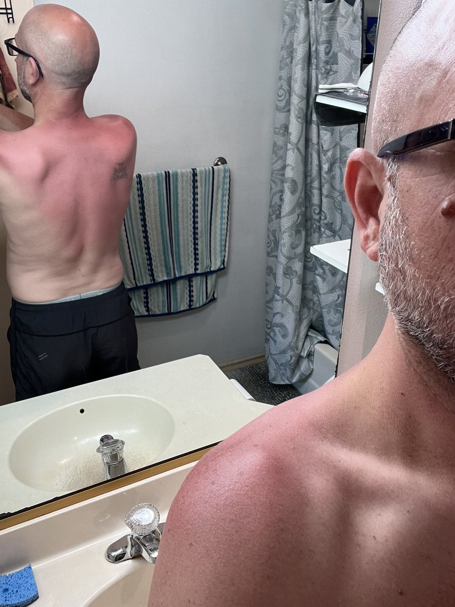 @brownlynne @blackcartrent This is a direct result of Twittering while Tanning. 

Leaned forward to argue with people about rideshare and discuss politics and next thing you know it’s 40 minutes later and I’m weird sunburn guy.