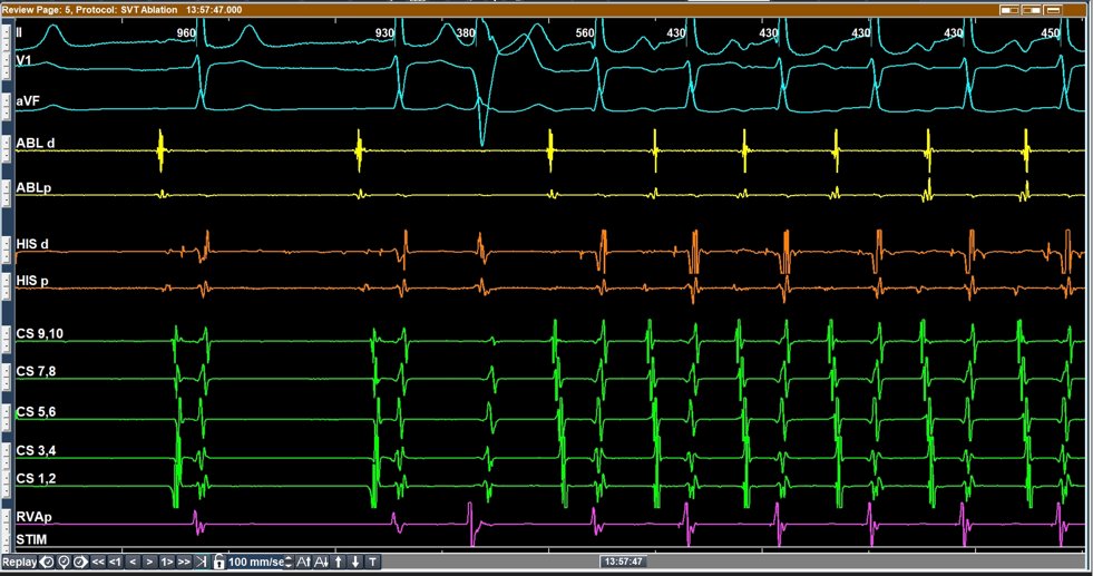 Mechanism of this SVT? Another trace for fellows and @ALFIEEP1