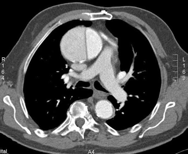 Tearing/ripping chest pain Altered mental status Severe Hypotension Muffled heart sounds Jugular venous distension What is the Diagnosis? What is the complications occuring here? Other complications? What is the classification of this pathology causing it? Treatment? Image