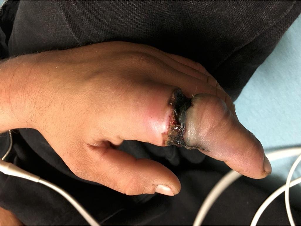 Digital Thermal Necrosis Resulting in Amputation After Removing a Tungsten Carbide Ring With a High-Speed Metal Burr #handwrist #trauma bit.ly/3yw1eND