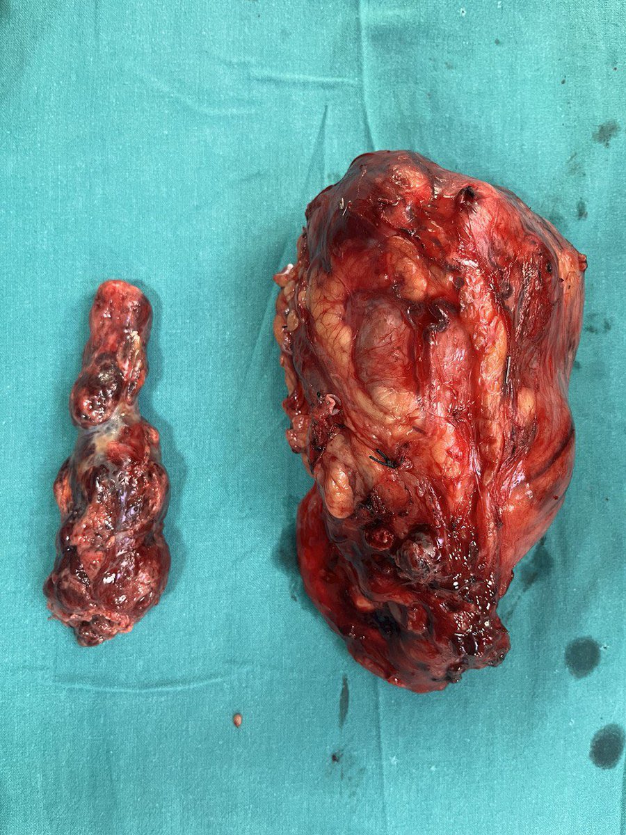 Level 4 thrombus in RCC is technically challenging. Happy to have successfully performed one in my case and the pt is doing well@usioffice @drgaganprakash @MahendraTMH @DrParimalGharia @PrashantDarakh @SpiessPhilippe @dipenjparekh @bonestumor @angryoldman27