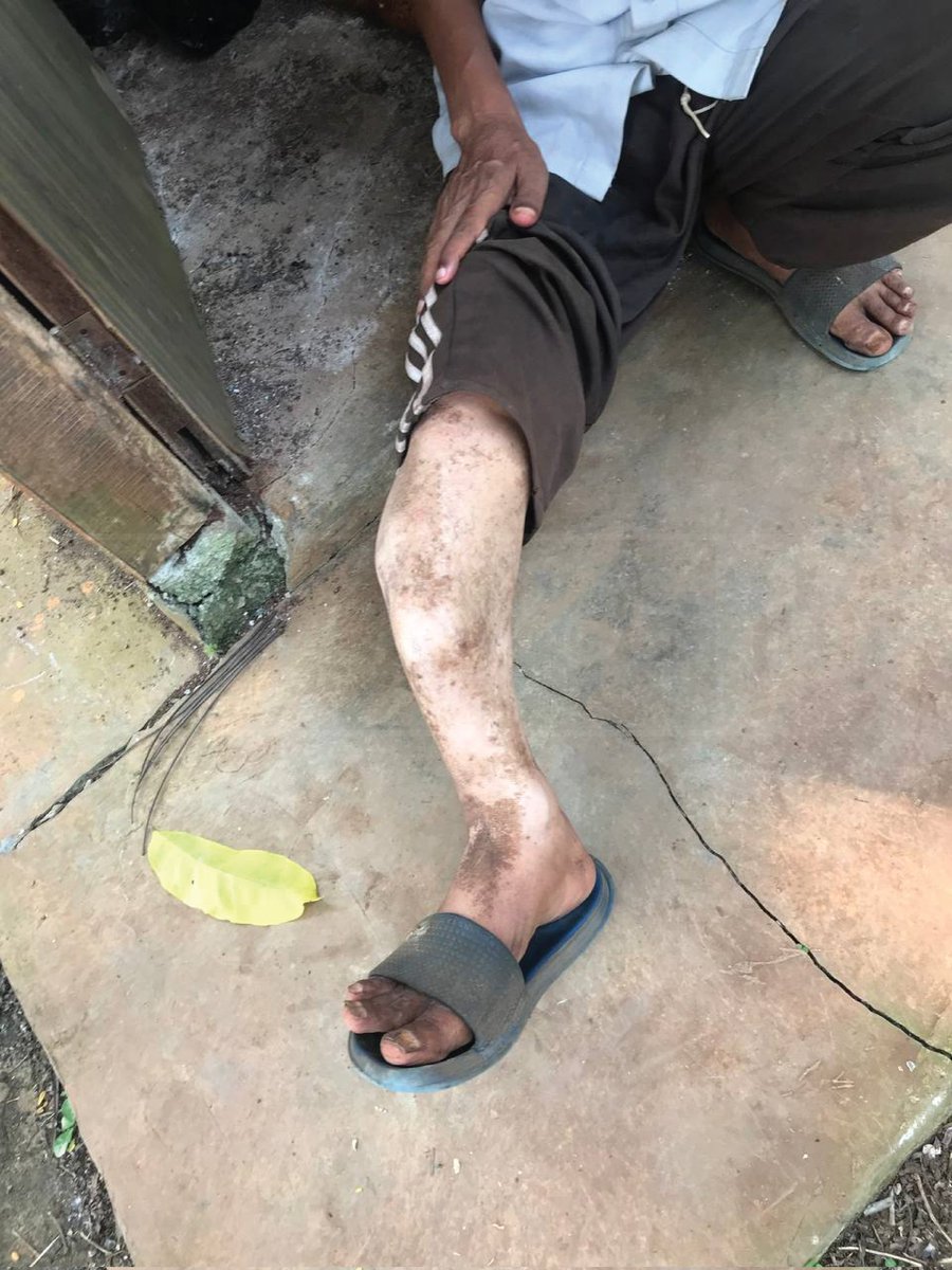 ayokitapeduli_'s tweet photo. Pak Dahlan ditelantarin setelah ngalamin kecelakaan yang bikin tulang kakinya patah dan kepalanya penyok.  

Sejak kejadian itu, ia jadi gagap kalau ngomong karena lekukan di kepalanya berdampak ke saraf dan jalannya pincang. https://t.co/4Qev4BAD1w
