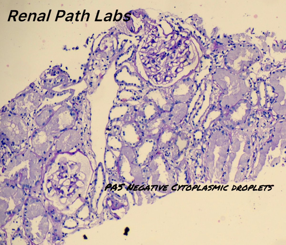 RenalPathLabs's tweet photo. Today’s gain!LCPT suspected on LM, confirmed by DIF-P. Routine DIF didn’t show any restriction!DIF-P is surely an imp. tool of Renal Path’s Armamentarium!
#PathTwitter #RenalPath #AskRenal #AskRenalPath #RenalPathLabsIndia #NephTwitter #RareRenalPathCases #PoojaMaheshwari https://t.co/7eoVL7p0xB