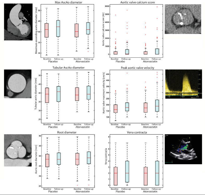 📡📡Just published BICATOR study showing no effect of atorvastatin in⬇️progression of ascending aorta dilation and aortic valve calcification in BAV. Congratulations to the research group led by @JRodriPalomares and with @EFerrerSistach collaborating from @hgermanstrias 👏👏