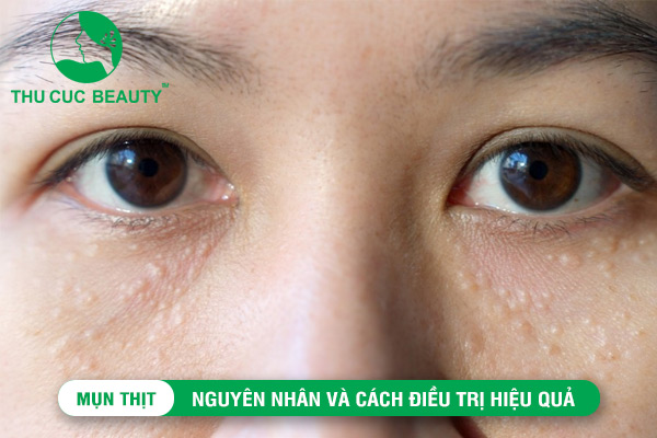 thucucsaigon's tweet photo. Mụn thịt: Nguyên nhân và cách điều trị hiệu quả
Tìm hiểu ngay
https://t.co/dL1l6bWpRH
-----
Thông tin liên hệ
Điện thoại: 1900 1920 - 0964 080 999
Địa chỉ: 218 Điện Biên Phủ, Quận 3, TP Hồ Chí Minh.
Email: contact@thucucclinics.vn
#thucucsaigon #trimun #lamdepda https://t.co/KFjnxWVTd8
