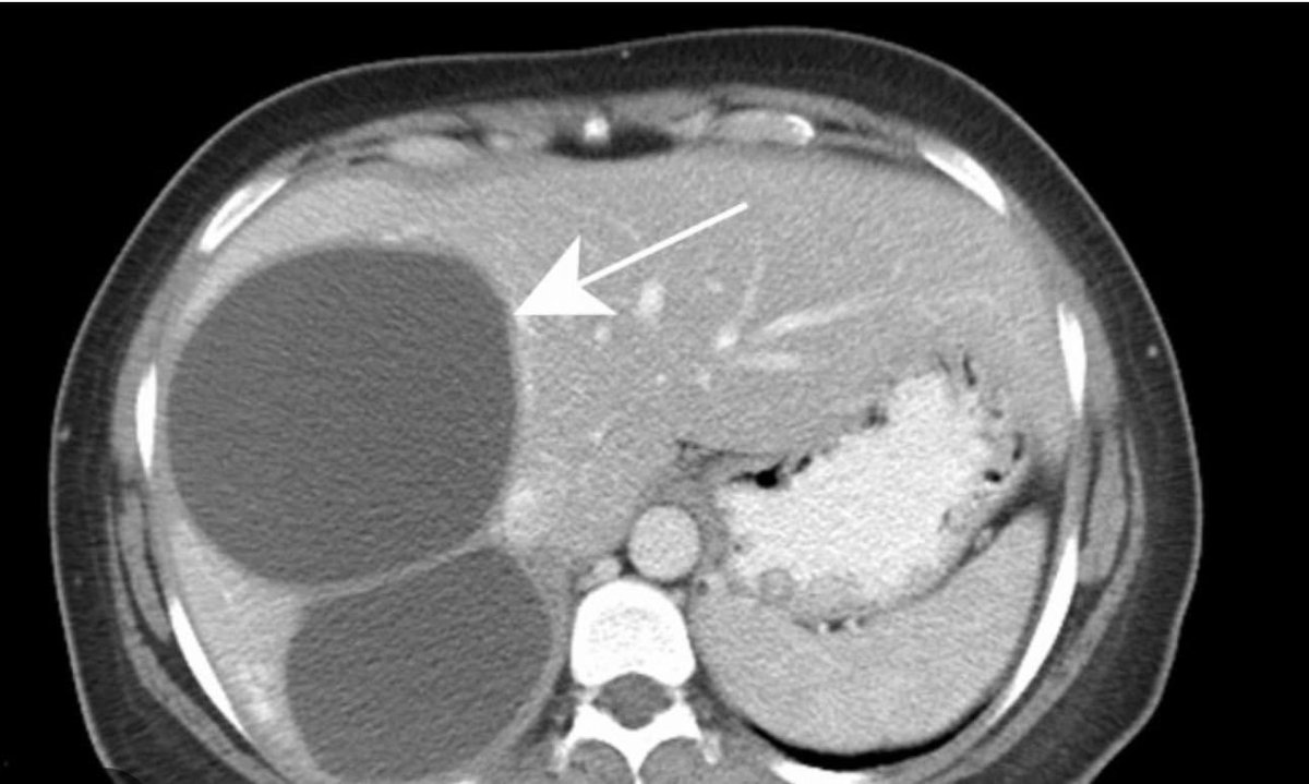 Patient presents because of upper right abdominal pain and jaundice. 
CT scan of the abdomen showed this. What is your diagnosis?

#MedEd 
#MEDHM 
#MedX 
@IhabFathiSulima