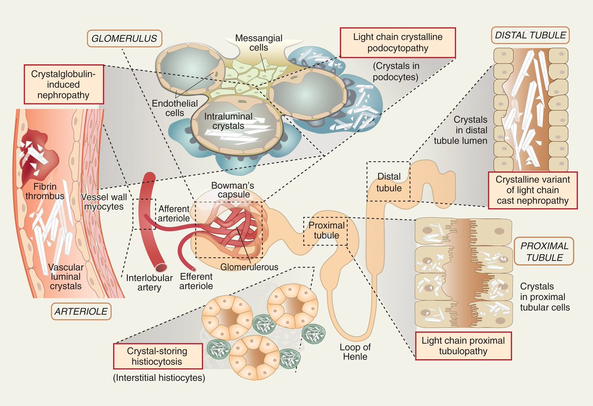 Dr Priti MD,FASN🇮🇳 (प्रिति) (@priti899) on Twitter photo 💥Monoclonal immunoglobulin crystalline nephropathies. <a href="/ISNeducation/">ISN Education</a>
kidney-international.org/article/S0085-… 💥Monoclonal immunoglobulin crystalline nephropathies. <a href="/ISNeducation/">ISN Education</a>
kidney-international.org/article/S0085-…