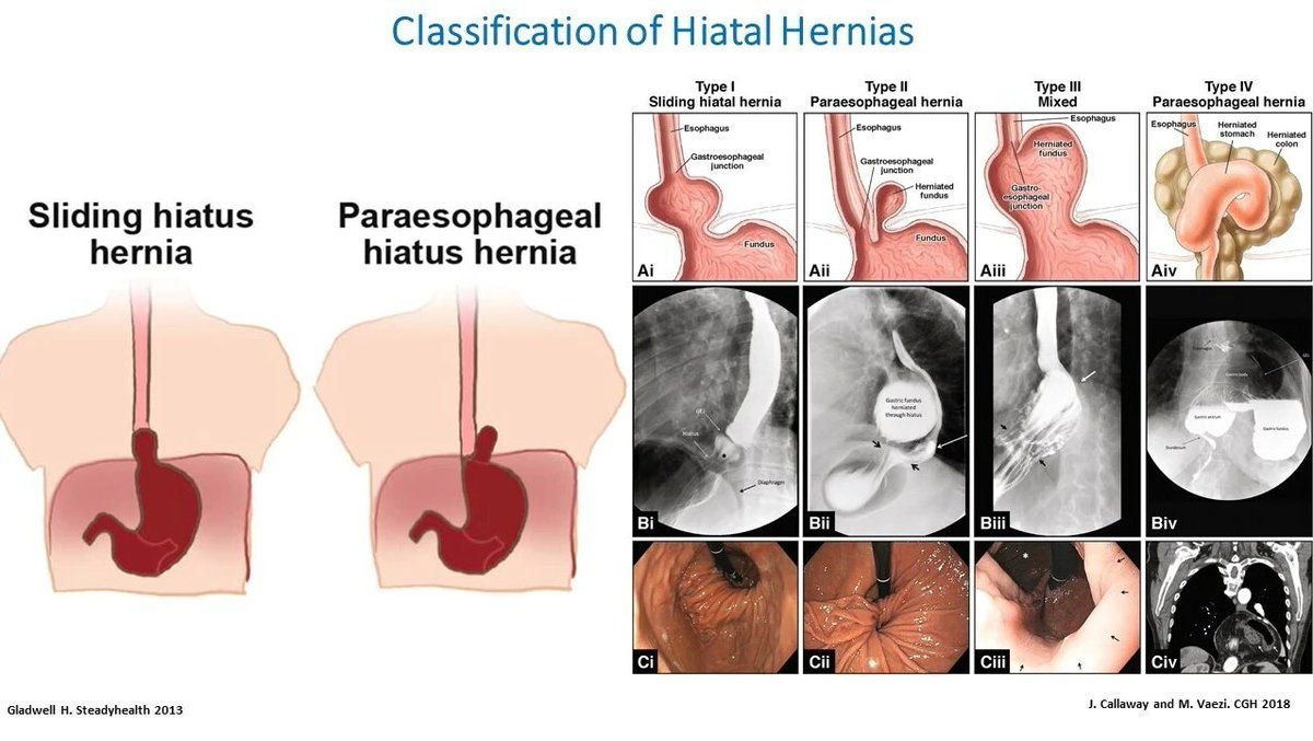 Classification of Hiatal Hernias

• Sliding hiatus hernia

• Paraesophageal hiatus hernia
