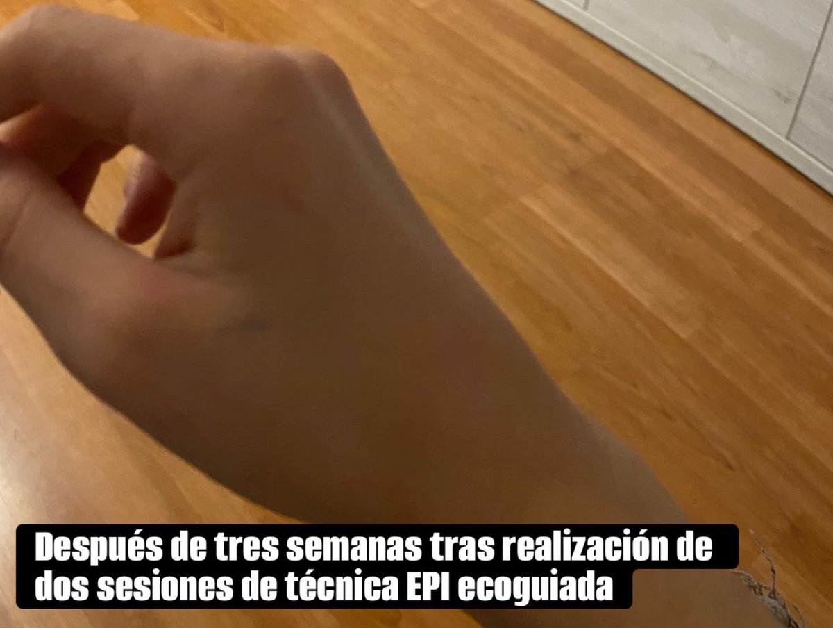 El tratamiento del ganglión con EPI ecoguiada evita el paso por el quirófano. 📸 Ganglión en el dorso de la mano que además de dolor e impotencia funcional afectaba al estado emocional de la paciente. 22 años de experiencia, +12.000 pacientes felices con los resultados 🚀.
