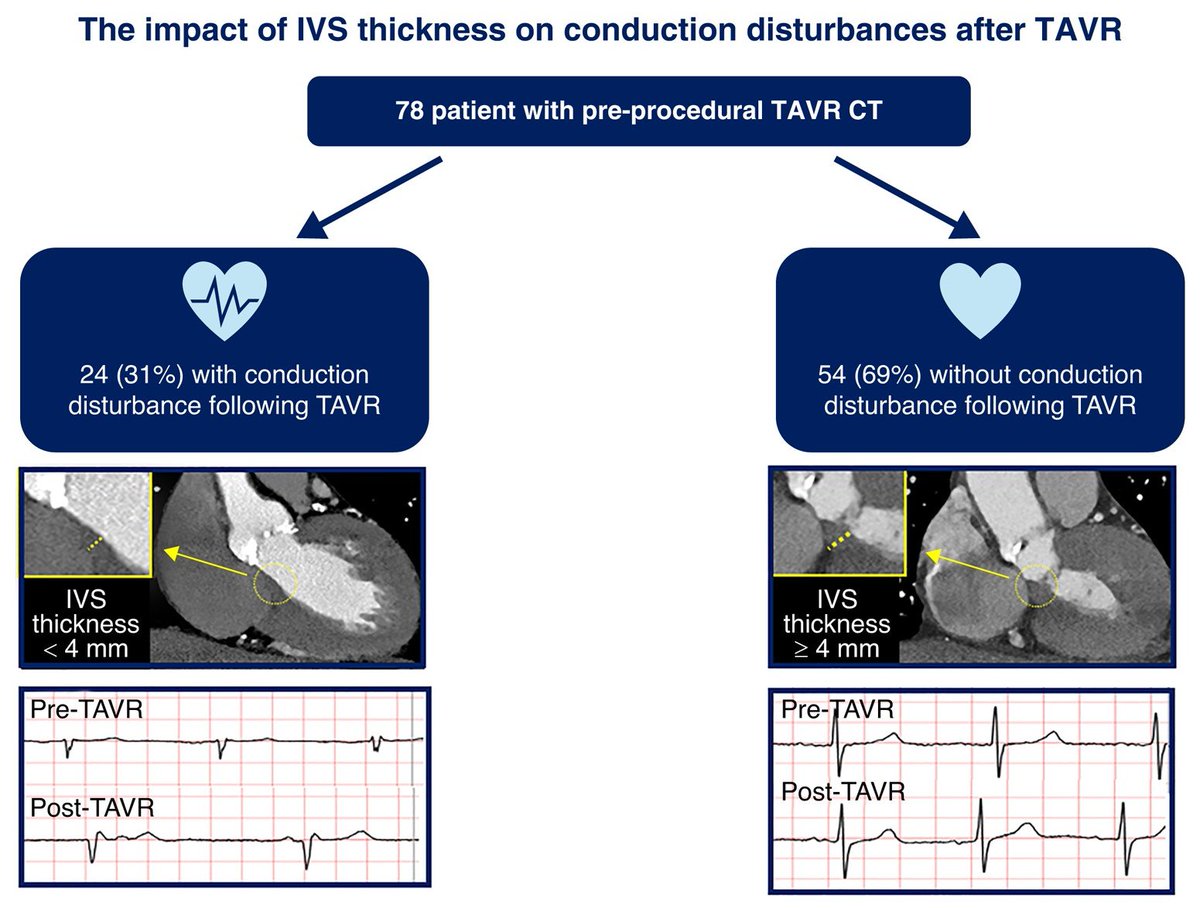 📢#Europace #Cardiotwitter #Epeeps Do you know that basal Interventricular septal thickness on CCT could predict conduction disturbances in patients undergoing TAVI❓ 🆓doi.org/10.1093/europa… @GiulioConte9 @FraSantoroMD @marcovitoloMD @AndyZhangMD @Dominik_Linz @ESC_Journals