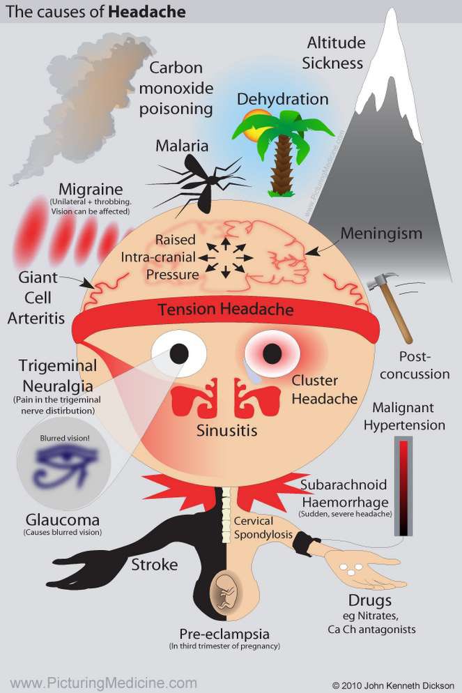 Cause of Headache #Meded #medx #Headache