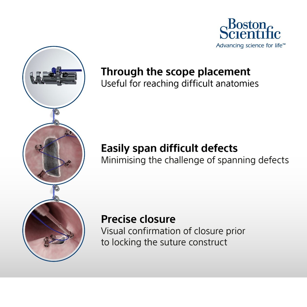 EoA for @BSCEMEA_Endo:

X-Tack allows for suture-based, deep submucosal and intramuscular-enhanced fixation through a standard gastroscope or colonoscope​, allowing you to ​close larger and irregular shaped defects. 

Learn more here:
bit.ly/44YR5VA