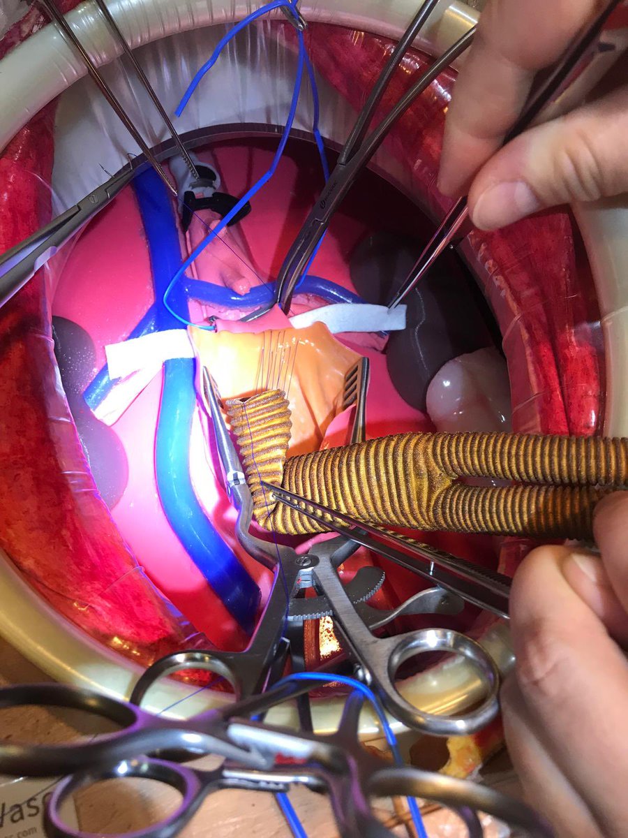 We’re back with a recap of The Aorta Workshop in Helsinki 2024 with SimuVasc Models! 
Stay tuned for new courses and updates coming soon!
#simuvasc #vascularsimulation #aorticworkshop #vascularsurgerysimulation #helsinkihospital