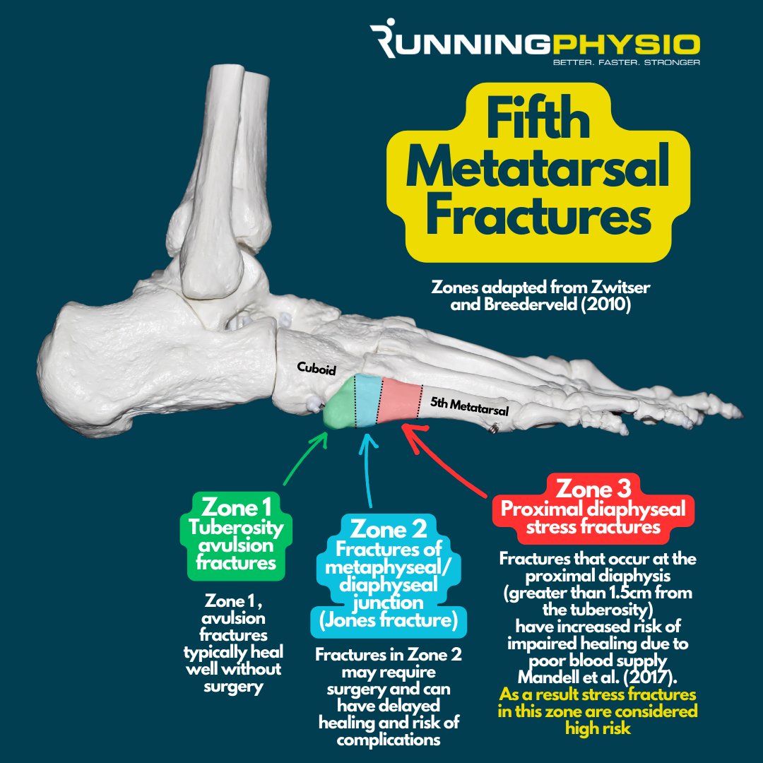 Why are some fifth metatarsal stress fractures considered 'high risk'? (See graphic for details)