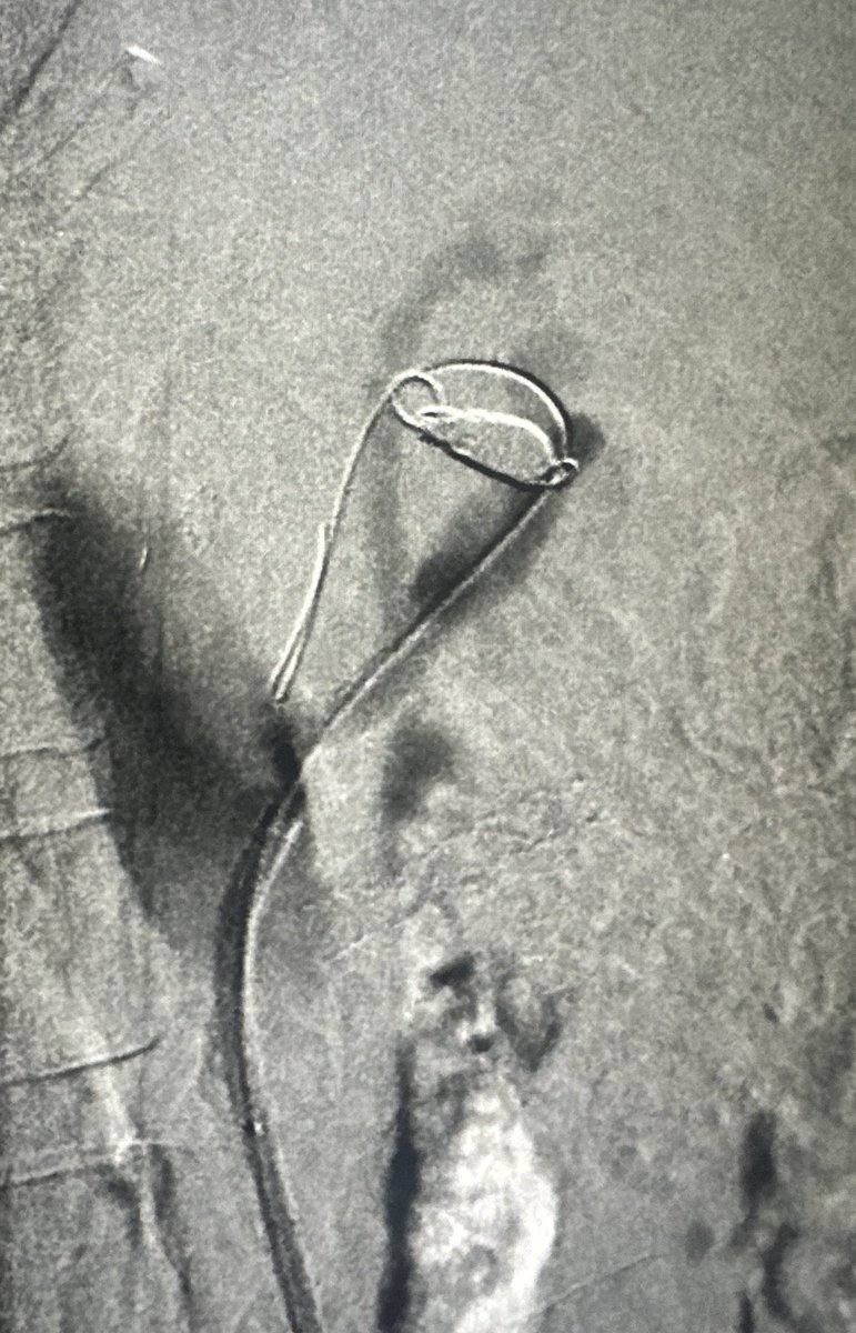 Abdominal pain attributed to spleen and need for splenectomy. VIR consulted for splenic embo. Further review suggests Chronic Mesenteric Ischemia. Nice little celiac and SMA revasc and prox splenic embo. Abdominal pain has resolved. @ChengaziMD #irad #vascular #medtwitter