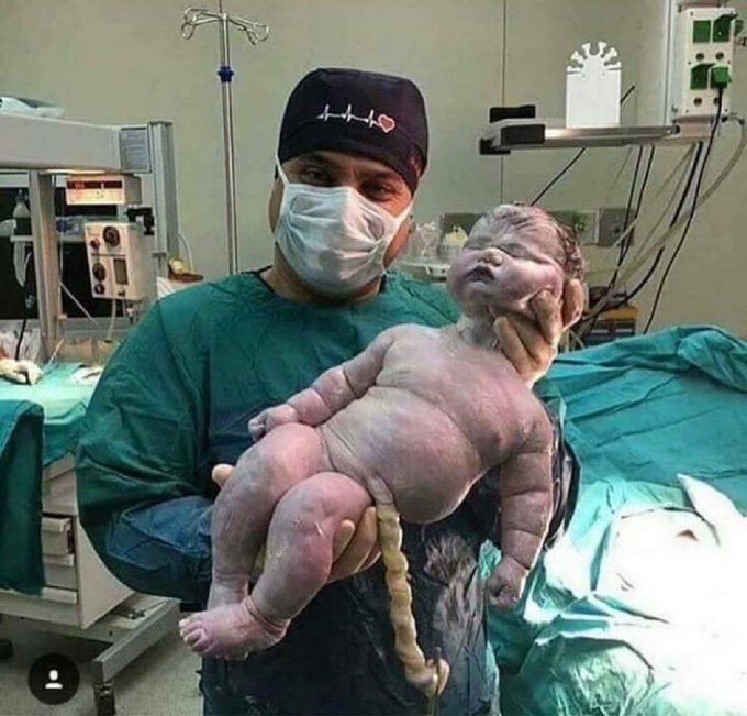 This image always amazes me! The biggest baby by natural birth weighting roughly 17.47 pounds (7.9 kg) and 22.5 inches (57.5 cm) long! 😶