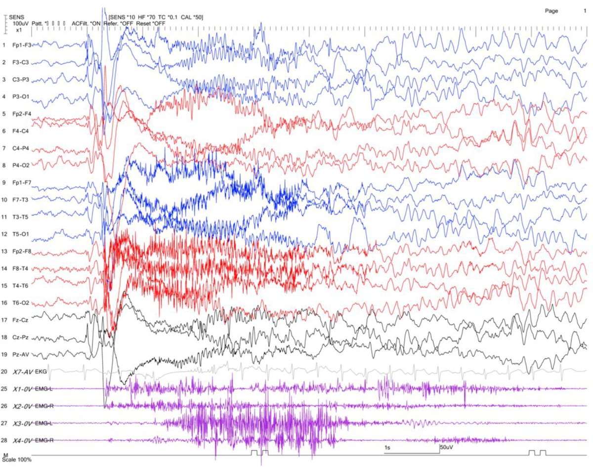 [Epilepsy] Zhou et al.: 'In comparison to other types of epilepsy, generalized epilepsy with myoclonic-to-tonic seizures demonstrated a more favorable prognosis.' doi.org/10.1016/j.clin…