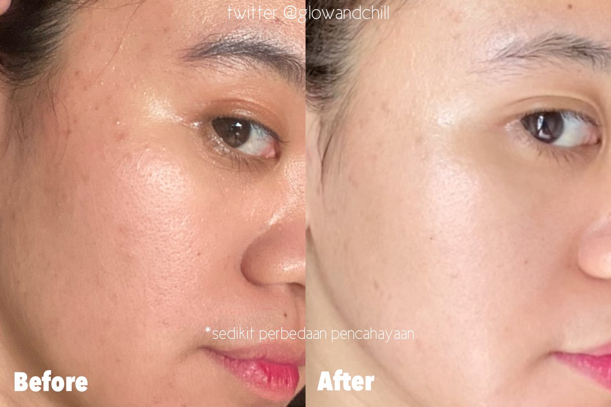 Ayo pakai retinol!!!! Selain bagus bgt buat anti-aging , retinol juga bagus buat kulit berjerawat kaya aku 😭💯

Setiap pms juga jerawat  jadi ga terlalu ngamuk munculnya ✨🥇 

Liat beruntusan akuuu ⤵️

#racuninskincare