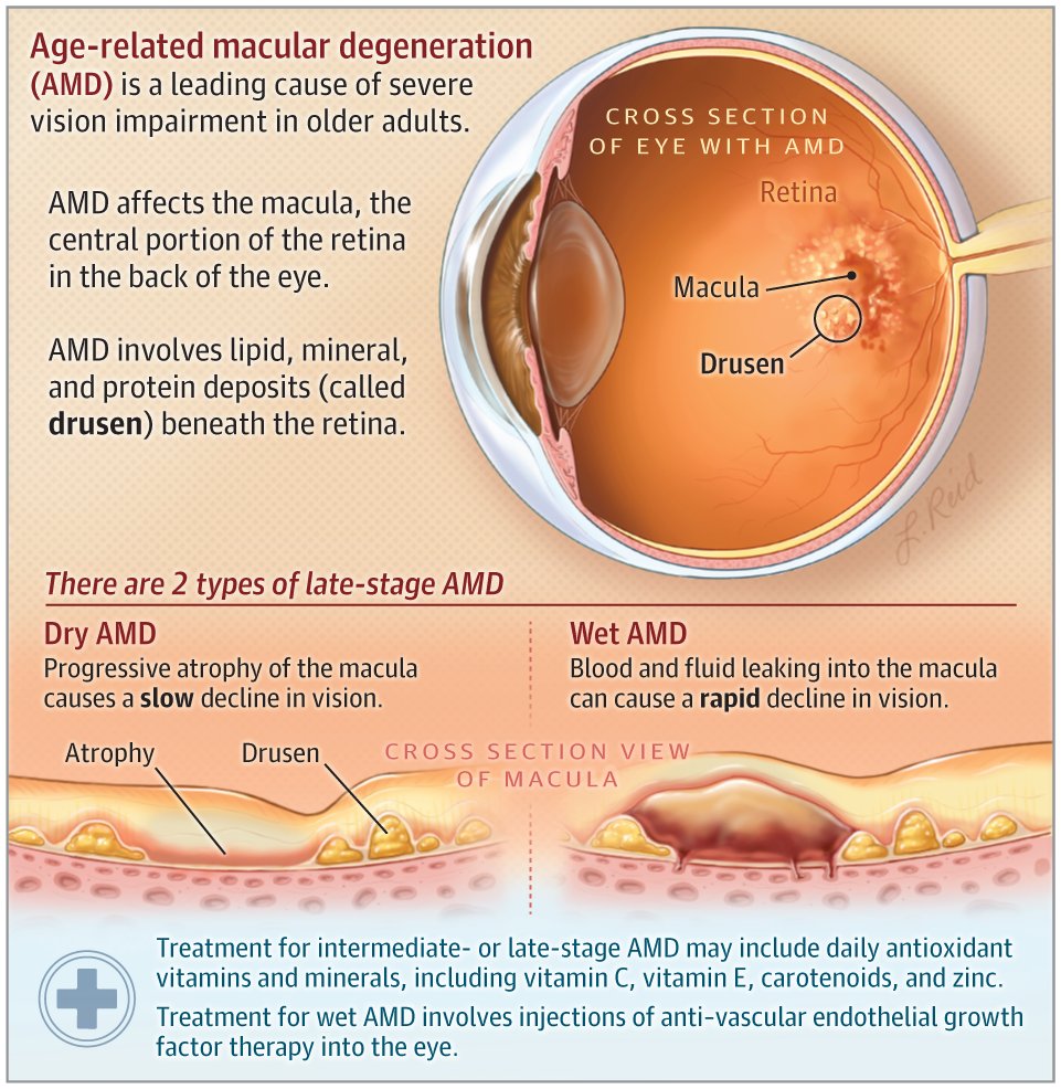 Age-related macular degeneration causes severe vision impairment in older adults. This JAMA Patient Page describes AMD development and progression; symptoms and risk factors; and diagnosis, monitoring, and treatment. ja.ma/3wUsULy