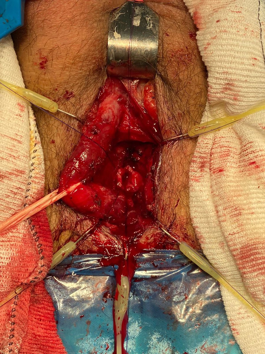 MauroMMeo's tweet photo. Caso del día: 

Paciente masculino de 58 años con estenosis de uretra bulbar secundaria a RTUP. Se realizó una Uretroplastia termino - terminal con conservación bulbar.

58-year-old male patient with bulbar urethral stricture secondary to TURP. A NT-EPA was performed.

#CCU https://t.co/Q6E35VowOO