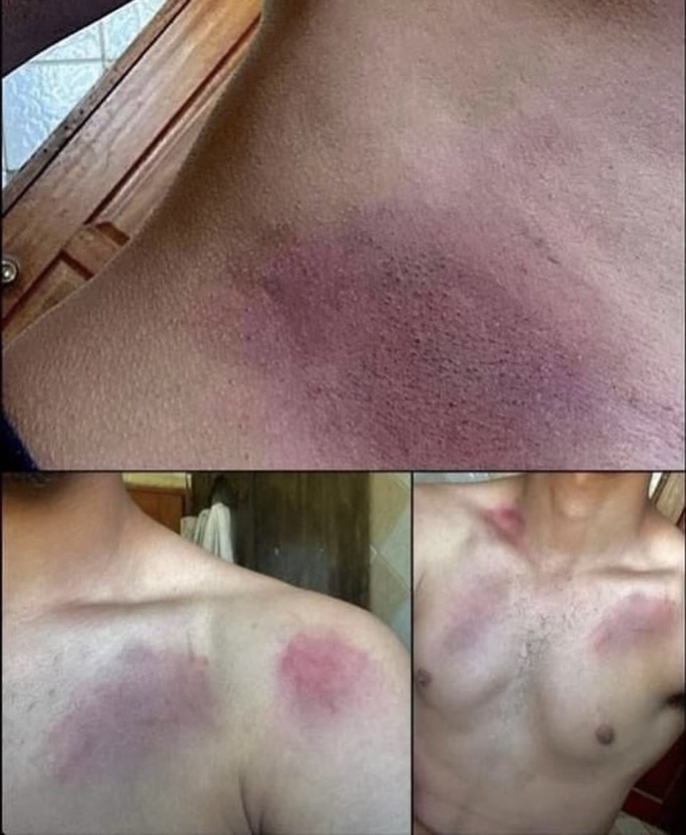 After 10 days of detention by Israeli occupation forces, the traces of torture on the body of Palestinian prisoner Amir Shuja’iyeh from Ramallah are evident.