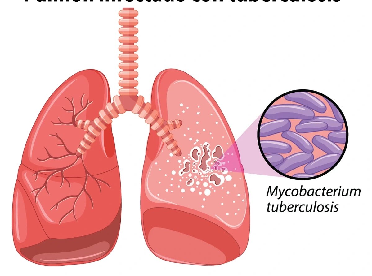 HerbalistChief's tweet image. Top herbs for curing TUBERCULOSIS 

🌿Bitter kola
🌿Neem tree
🌿Asthma herb
🌿Ginger
🌿Garlic

Boil either of the herbs in water for 15-20 mins. Drink a teacupful twice daily. Remember to grate your bitter kola, garlic and ginger before using it. 

Nature heals. 
#BackToEden