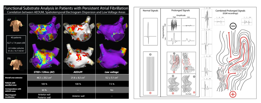 JICE (@jice_ep) on Twitter photo 🚨Latest #FreeRead Article in
<a href="/JICE_EP/">JICE</a>
Functional Substrate Analysis in Patients with Persistent Atrial Fibrillation
🧐📖rdcu.be/dJyZ6
by <a href="/PietroRossiEP/">Pietro Rossi</a>, <a href="/michelefg91/">Michele Magnocavallo</a>, <a href="/FilippoCauti/">Filippo Maria Cauti</a>, <a href="/MarcoPolselliMD/">Marco Polselli</a>, <a href="/MartaNiscola/">Marta Niscola</a>, <a href="/dogi84md/">Domenico Giovanni Della Rocca, MD</a>, Ambra del Greco, Luigi Iaia, Raffaele 🚨Latest #FreeRead Article in
<a href="/JICE_EP/">JICE</a>
Functional Substrate Analysis in Patients with Persistent Atrial Fibrillation
🧐📖rdcu.be/dJyZ6
by <a href="/PietroRossiEP/">Pietro Rossi</a>, <a href="/michelefg91/">Michele Magnocavallo</a>, <a href="/FilippoCauti/">Filippo Maria Cauti</a>, <a href="/MarcoPolselliMD/">Marco Polselli</a>, <a href="/MartaNiscola/">Marta Niscola</a>, <a href="/dogi84md/">Domenico Giovanni Della Rocca, MD</a>, Ambra del Greco, Luigi Iaia, Raffaele