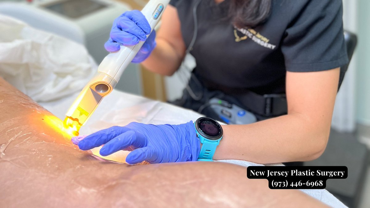 Say goodbye to #spiderveins with laser treatment by Kimmy at New Jersey Plastic Surgery. Experience the power of advanced technology and reclaim flawless, vein-free legs. Call 973-446-6968 now to book your appointment.

newjerseyplasticsurgery.com/consultation/