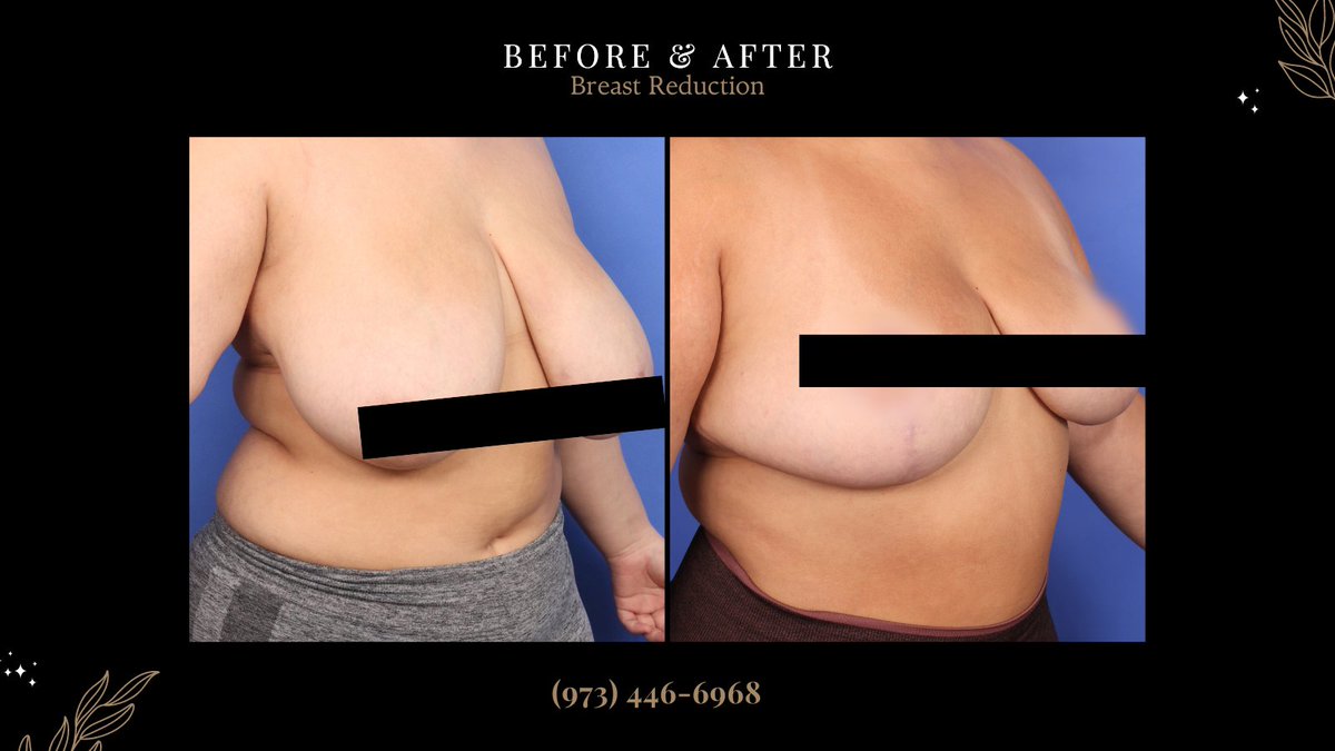 Considering breast reduction surgery? It's more than just a cosmetic choice—it can relieve back pain, improve posture, and boost self-confidence. Call 973-446-6968 to book a consult.

#breastreduction #booknow

newjerseyplasticsurgery.com/consultation/
